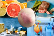 Bệnh nhân vẩy nến nên sử dụng thực phẩm nào?