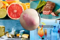 Bệnh nhân vẩy nến nên sử dụng thực phẩm nào?