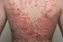 Dinh dưỡng phù hợp kiểm soát và cải thiện bệnh vảy nến