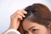 Bác sĩ giải thích cho việc tóc bạc sớm ở người trẻ