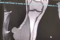 2 lần phẫu thuật u nhỏ như vảy ốc mới phát hiện ung thư di căn