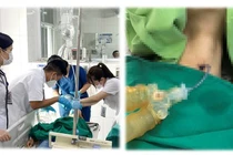 Kẹt tăm bông khi vệ sinh vị trí mở khí quản bệnh nhân nguy kịch