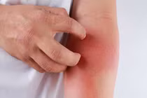 Các phương pháp xét nghiệm bệnh dị ứng