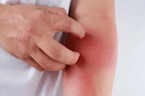 Các phương pháp xét nghiệm bệnh dị ứng