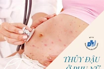 Mang thai cẩn thận tử vong vì thủy đậu