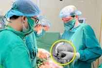 Lấy khối u xơ tử cung kích thước khủng