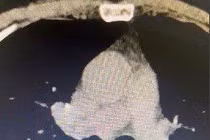 Ho ra máu phát hiện xương lợn hóc mắc kẹt trong phế quản cả năm