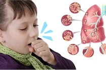 Nguyên nhân ho kéo dài ở trẻ cha mẹ cần biết để chữa kịp thời