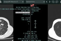 Cách hạn chế tác dụng phụ khi điều trị ung thư phổi