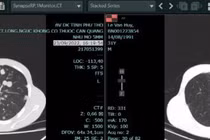 Cách hạn chế tác dụng phụ khi điều trị ung thư phổi