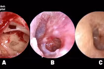 Thủng màng nhĩ do bông ngoáy tai