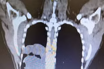 Đau tức bụng nhiều ngày, người đàn ông 43 tuổi phát hiện u trung thất "khủng"