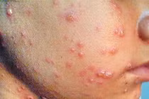 Hà Nội: Dịch thủy đậu gia tăng trong trường học 