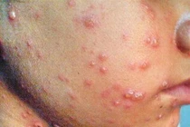 Hà Nội: Dịch thủy đậu gia tăng trong trường học 