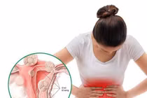 Thiếu nữ 20 tuổi mắc u xơ tử cung do nghiện trà sữa, đồ chiên rán