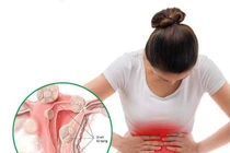 Thiếu nữ 20 tuổi mắc u xơ tử cung do nghiện trà sữa, đồ chiên rán