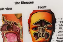  Biến chứng viêm mũi xoang, viêm vòm, viêm họng sau điều trị ung thư