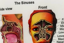  Biến chứng viêm mũi xoang, viêm vòm, viêm họng sau điều trị ung thư