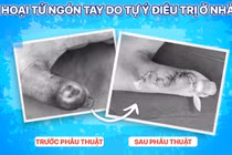 Đắp thuốc lá trị mụn trẻ 14 tuổi bị hoại tử ngón tay