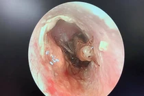 Gián bò vào tai khi đang ngủ, thai phụ suýt thủng màng nhĩ