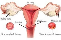 Rỉ máu liên tục vì đốt lộ tuyến không đúng phương pháp