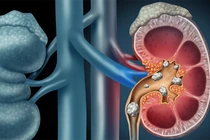 Các dấu hiệu bệnh sỏi thận