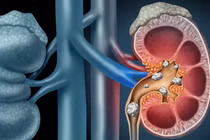 Các dấu hiệu bệnh sỏi thận