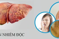 Đối tượng có nguy cơ mắc viêm gan nhiễm độc cấp