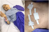 104 tuổi bị thoát vị bịt nguy hiểm được cứu sống thần kỳ