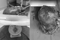 Lấy bỏ khối u 5,5kg “bao trùm” toàn bộ thận trái nam bệnh nhân