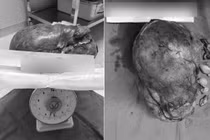 Lấy bỏ khối u 5,5kg “bao trùm” toàn bộ thận trái nam bệnh nhân