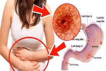 Nguyên nhân đau dạ dày mà dân văn phòng ai cũng mắc