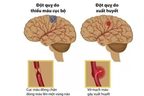 Bác sĩ mách cách tránh đột quỵ khi thời tiết chuyển lạnh