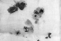 "Chơi" bình gas mini bé gái 5 tuổi bị dập não