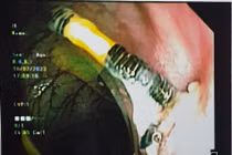 Vòng tránh thai đâm xuyên tử cung làm thủng đại tràng