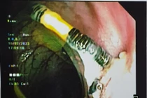 Vòng tránh thai đâm xuyên tử cung làm thủng đại tràng