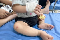 “ Né” bệnh Tay-Chân-Miệng diễn biến nặng thời điểm giao mùa ra sao