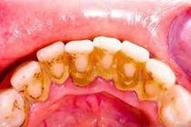 Chuyên gia chỉ rõ lý do viêm lợi và cách chữa