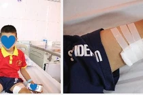 2 trẻ bị nhiễm tụ cầu vàng do chó cắn