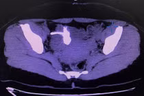 Sỏi bám kín vòng tránh thai đi lạc vào trong bàng quang