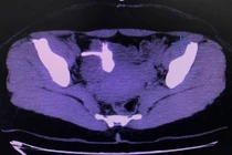 Sỏi bám kín vòng tránh thai đi lạc vào trong bàng quang