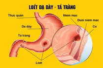 Bị viêm loét dạ dày: Nên ăn gì vào buổi sáng?