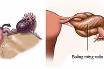 Bé 18 tháng tuổi bị cắt bỏ 1 buồng trứng