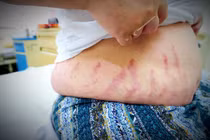 Lạm dụng thuốc xịt mũi, hai anh em ruột bị suy tuyến thượng thận