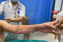 Dùng cồn nướng thức ăn nữ bệnh nhân 26 tuổi bỏng nặng