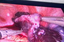 Bảo tồn thành công buồng trứng xoắn cho trẻ 5 tuổi