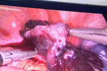 Bảo tồn thành công buồng trứng xoắn cho trẻ 5 tuổi