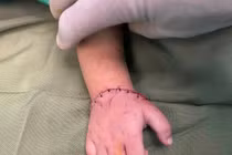 Mới 18 tháng tuổi đã bị đứt lìa bàn tay do máy cắt đá