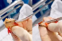 Bất ngờ vòng tránh thai bọc trong khối u xơ tử cung