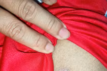 Mùa hè cẩn thận sốt mò gây viêm não và suy đa tạng